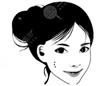 激光去痦子多少钱一次2025?