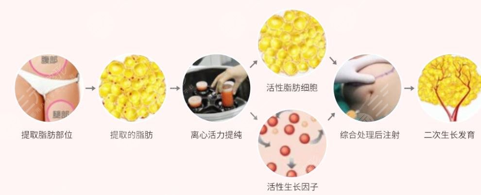 自体脂肪移植
