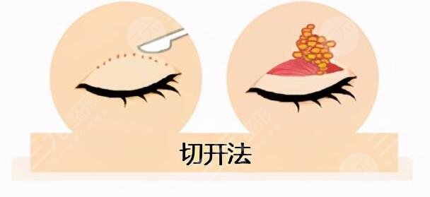 全切双眼皮