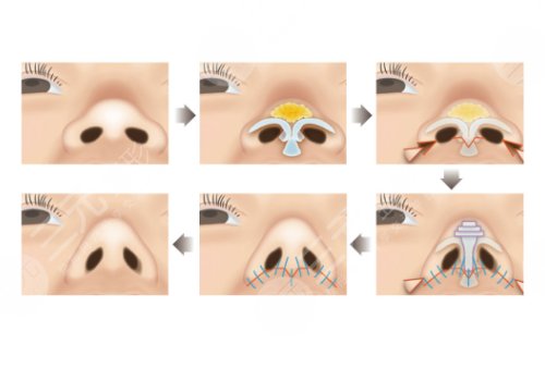 蒜头鼻缩小整形多少钱2024年,手术操作步骤,原理,术后效果同步一览
