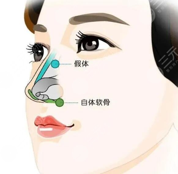 膨体材料隆鼻多少钱2025新版，手术材料的优缺点解析、术后护理小贴士~