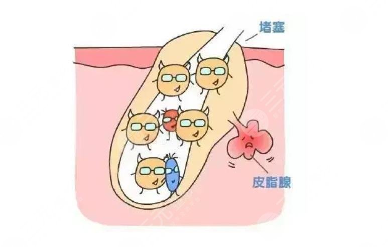 蕾特恩祛痘多?少钱一次?