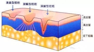 蕾特恩祛痘多?少钱一次?