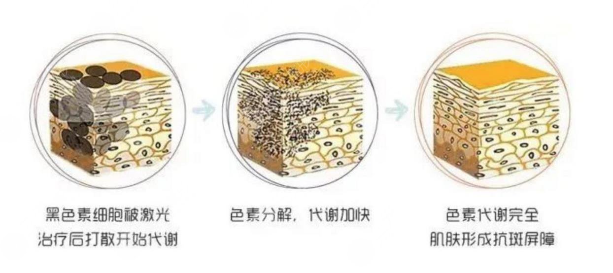 祛斑治疗的原理?是什么?
