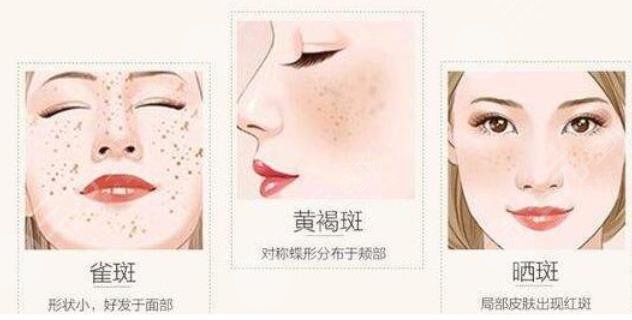 祛斑治疗的原理?是什么?