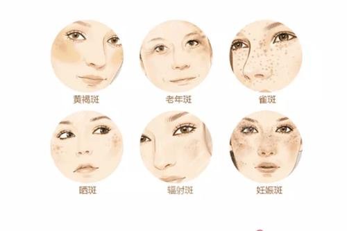 祛斑治疗的原理?是什么?