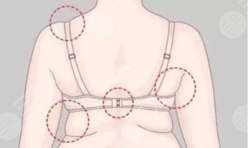 背部吸脂多少钱一次？哪些因素影响了吸脂手术的价格？注意事项有哪些？