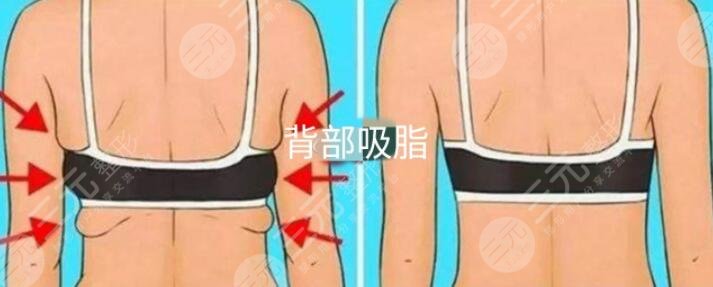 背部吸脂是什么原理?