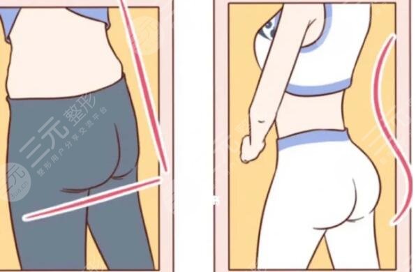 背部吸脂多少钱一次?