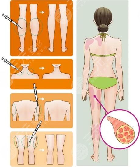 背部吸脂的注意事项