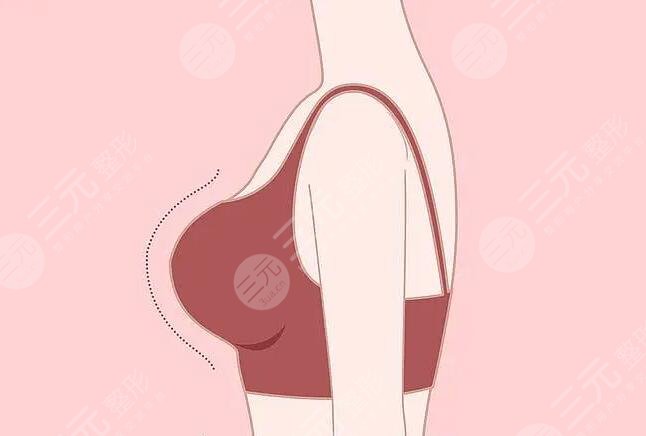 乳房整形