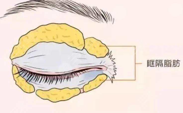 双眼皮抽脂