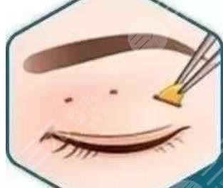 双眼皮抽脂