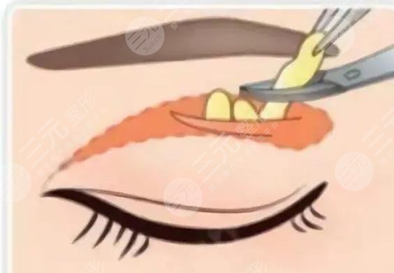 双眼皮抽脂
