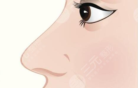 隆鼻
