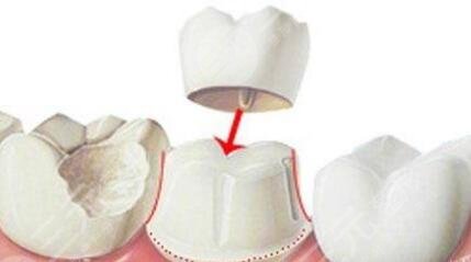 烤瓷牙和全瓷牙应该怎样选择?