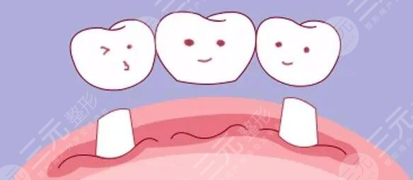 烤瓷牙能用多久呢?