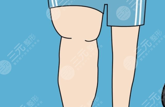 腿部吸脂