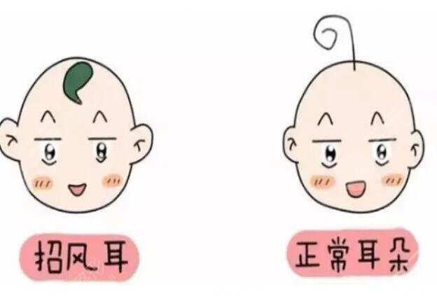 招风耳整形一般多少钱？