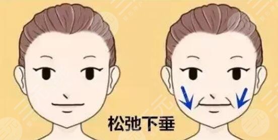 面部下垂提升术多少钱？具体术式、操作方案及步骤、预期果点击了解！