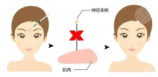 小拉皮除皱
