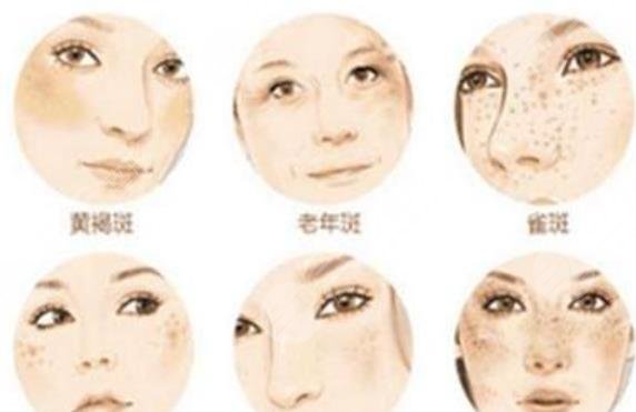 斑点