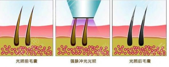 脱毛