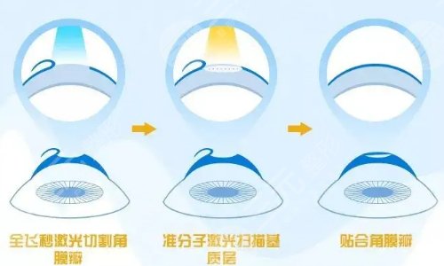 影响近视手术价格的因素都有哪些?
