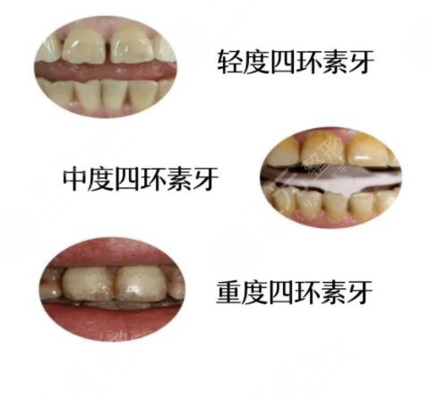 牙齿贴面最新行情解析：不同材质与价位