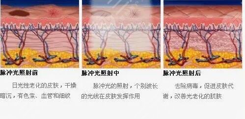 光子嫩肤