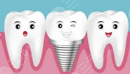 种植牙