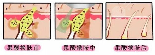 果酸换肤要注意什么?