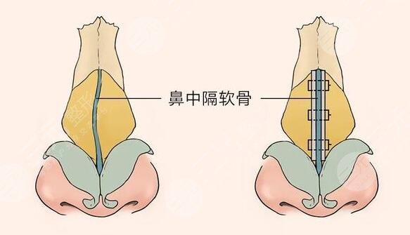 歪鼻是怎样造成的?