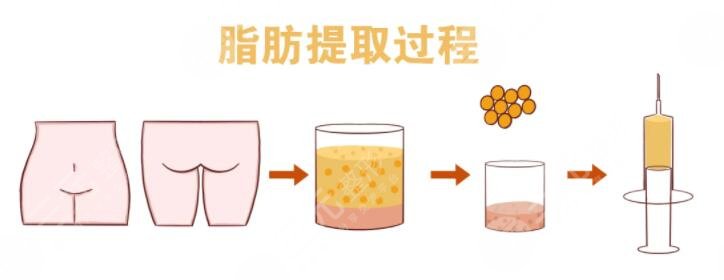 脂肪填充