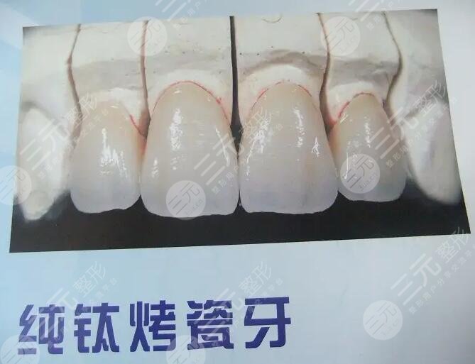 纯钛烤瓷牙的介绍