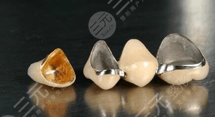 纯钛烤瓷牙价格多少钱一般？纯钛烤瓷牙的果及真人术后果参考中~