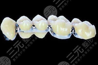纯钛烤瓷牙价格多少钱一般?纯钛烤瓷牙的果及真人术后果参考中~-城市