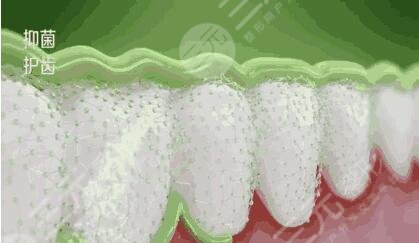 纯钛烤瓷牙安装案例