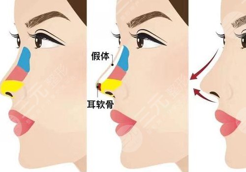 做个鼻梁需要多少钱费用？鼻梁垫高方式方法盘点，手术注意事项小白得知！-城市惠