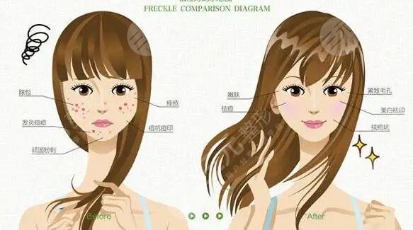 深圳艺星整形医院做点阵激光手术案例