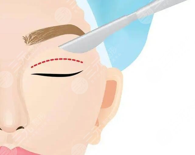 双眼皮手术