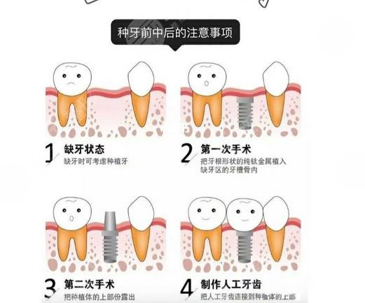 东莞康华医院口腔科种植牙案例