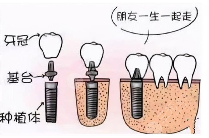 东莞康华医院口腔科种植牙案例