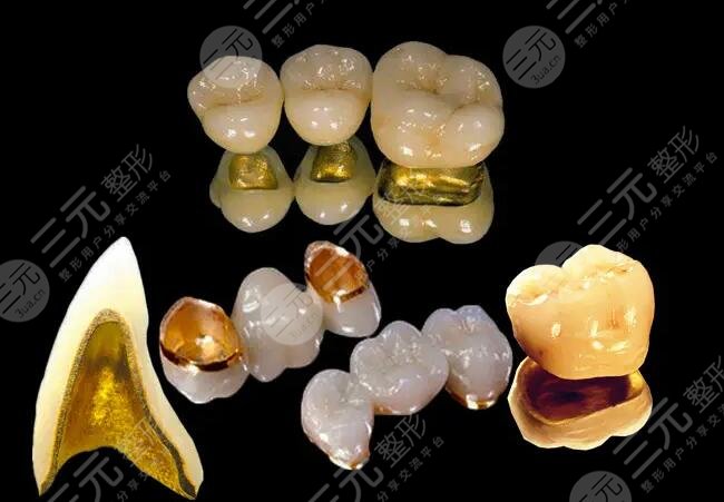 半贵金属烤瓷牙价格是多少?不同的价格影响因素呼之欲出~