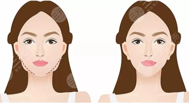 南京市第一医院整形科瘦脸案例介绍