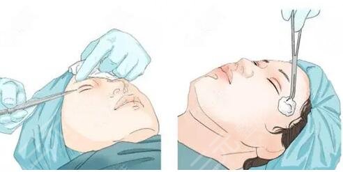 南京市第二医院双眼皮价位表