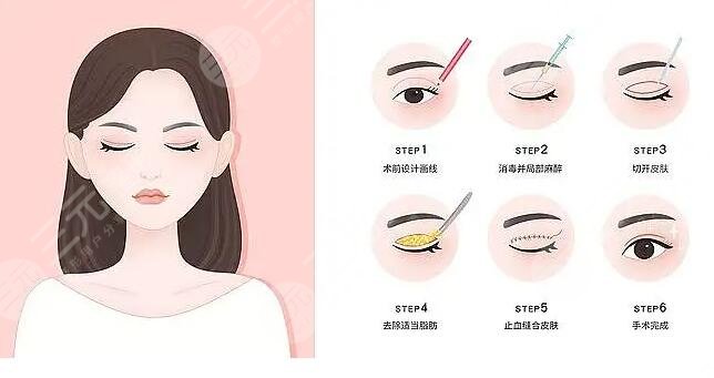 南京市第二医院双眼皮的案例介绍