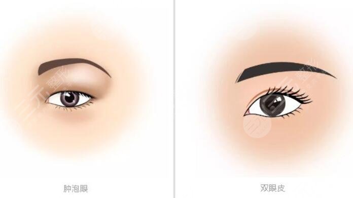 南京市第二医院双眼皮的案例介绍