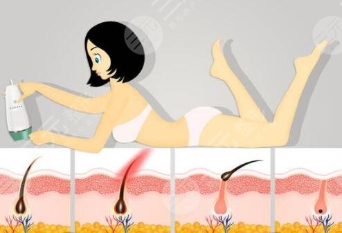 吉大一院激光美容科激光脱毛案例