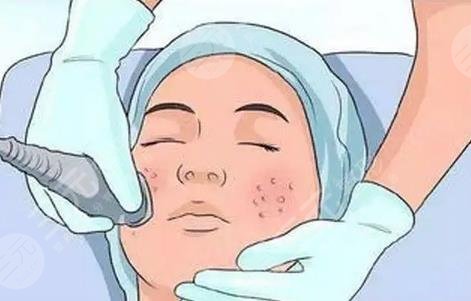 激光去痘坑多少钱